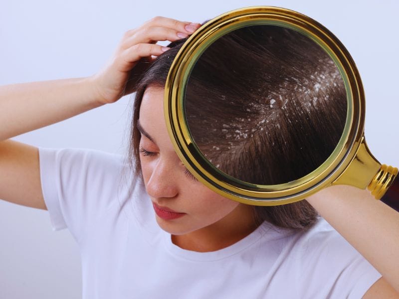 Close-up of a woman examining her scalp with a magnifying glass, highlighting visible dandruff and dry scalp concerns.