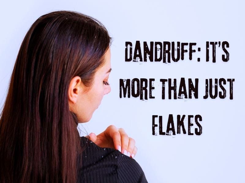 Woman checking dandruff on shoulder with bold text: 'Dandruff: It's More Than Just Flakes.