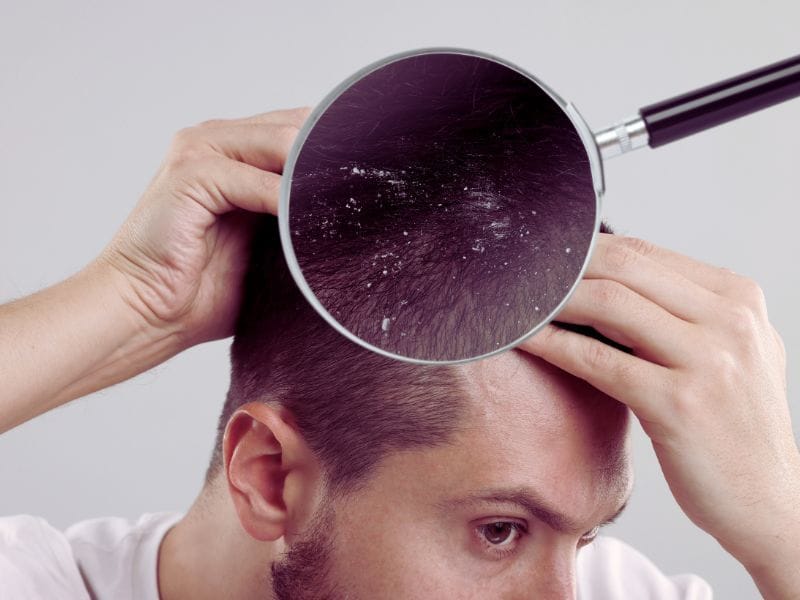 Man inspecting his scalp with a magnifying glass, revealing visible dandruff flakes on his hair.